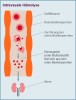 Intravasale Hämolyse bei PNH: Zerfall roter Blutkörperchen innerhalb des Blutgefäßsystems